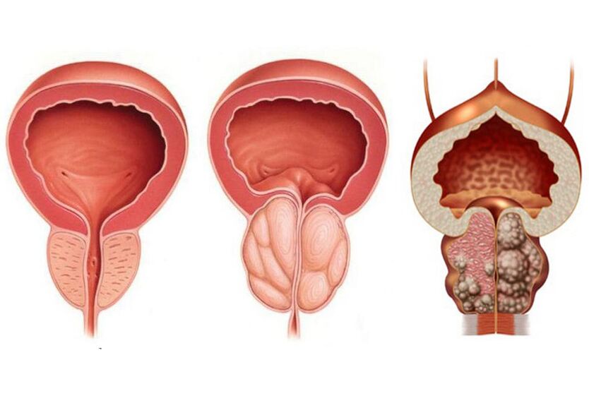 Phase de prostatite et la nécessité d'utiliser pleinement la prostavit