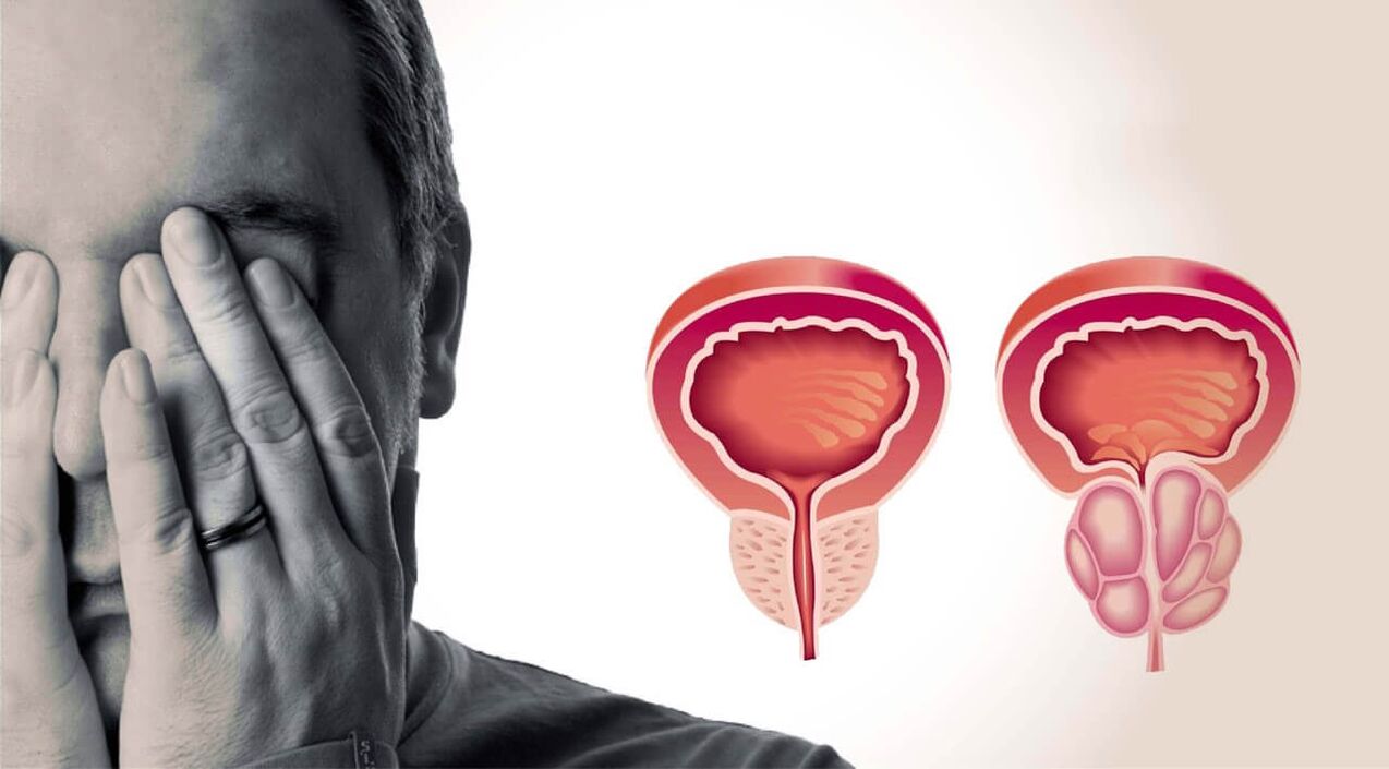 Prostate saine et douloureuse chez les hommes